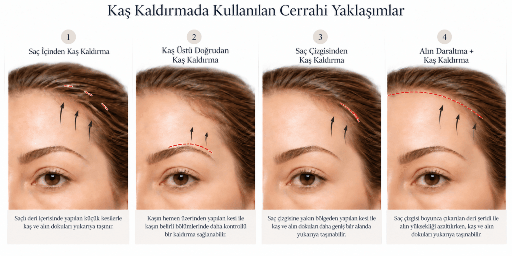 Kaş kaldırmada kullanılan cerrahi yaklaşımları gösteren infografik: saç içinden kaş kaldırma, kaş üstü doğrudan kaş kaldırma, alın daraltma ile kaş kaldırma ve saç çizgisinden kaş kaldırma.