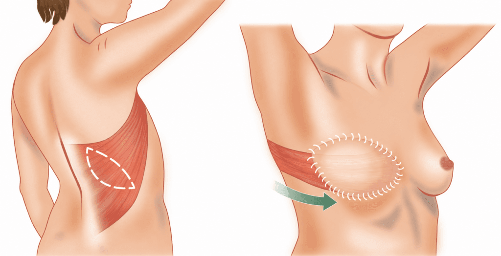 Latissimus Dorsi Flep ile Meme Rekonstrüksiyonu

Latissimus dorsi flebinde sırt bölgesindeki geniş sırt kası, üzerindeki deri ve yağ dokusuyla birlikte meme bölgesine taşınır.

Flep kendi kan dolaşımını koruyarak göğüs ön duvarına aktarılır. Bazı hastalarda tek başına yeterli hacmi sağlayabilirken, çoğu hastada istenilen meme hacmine ulaşmak için implant ile birlikte kullanılması gerekebilir.

Özellikle göğüs ön duvarındaki cilt ve yumuşak dokuların yetersiz olduğu seçilmiş hastalarda yararlı olabilir.

Ancak sırt bölgesinde ek bir cerrahi alan ve iz oluşturur; seroma ve bazı hastalarda fonksiyonel etkiler görülebilir. Bu nedenle her hastaya rutin olarak uygulanması gereken bir yöntem değildir.